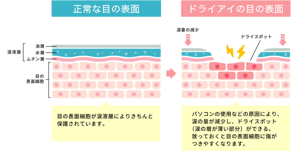 正常な目の表面とドライアイの目の表面