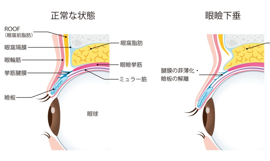 眼瞼下垂